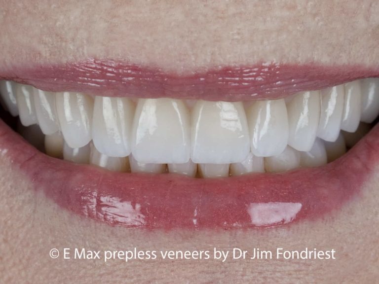 Veneers without drilling No Drill Veneers Save enamel