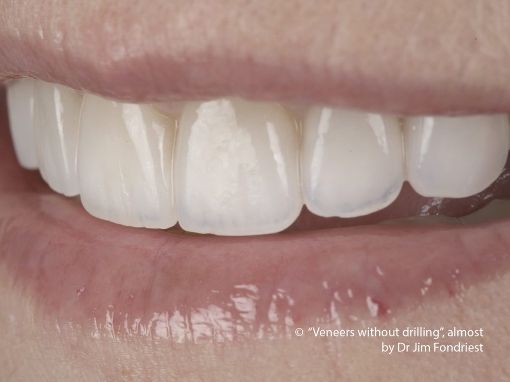 Tooth Veneers without drilling