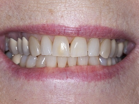 Poorly matched crowns, veneers, bonding