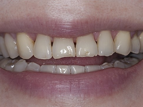 Black Triangles between teeth Black Triangles between teeth