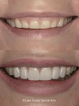Gum lift before and after