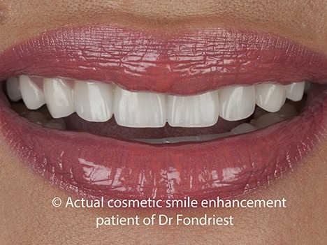 Porcelain veneers to replace bonding