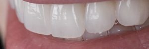 tooth covers