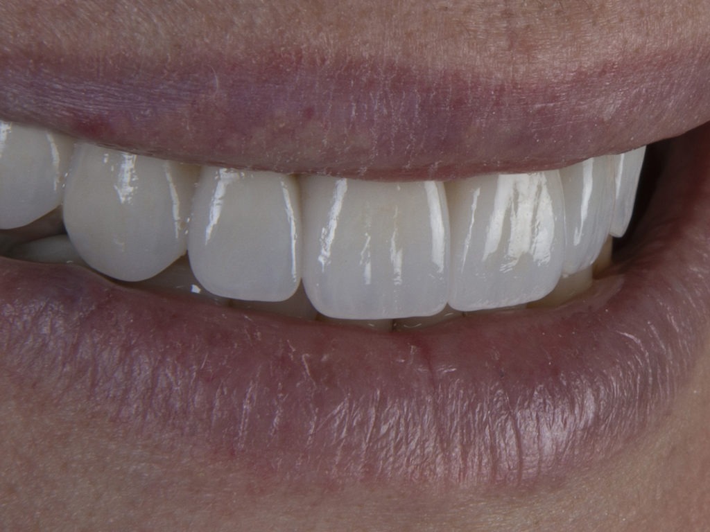 Smile makeover by Dr.Fondriest Best Cosmetic Dentistry tjhat can be done