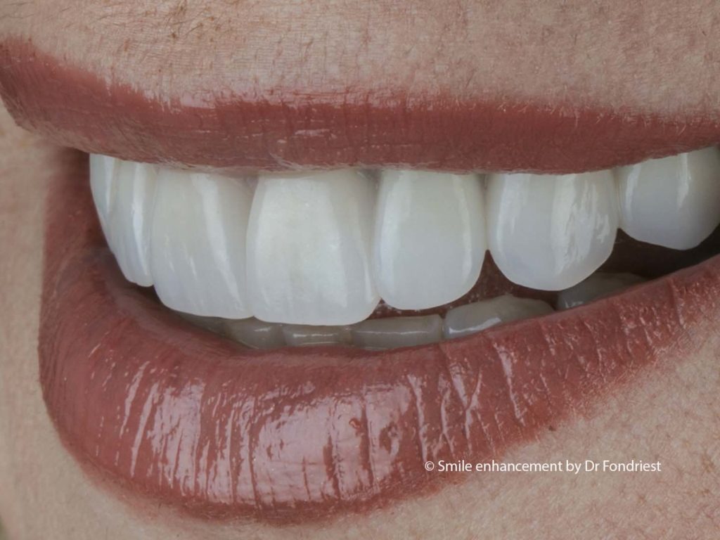 Porcelain Veneers | Dental Veneers Porcelain veneer