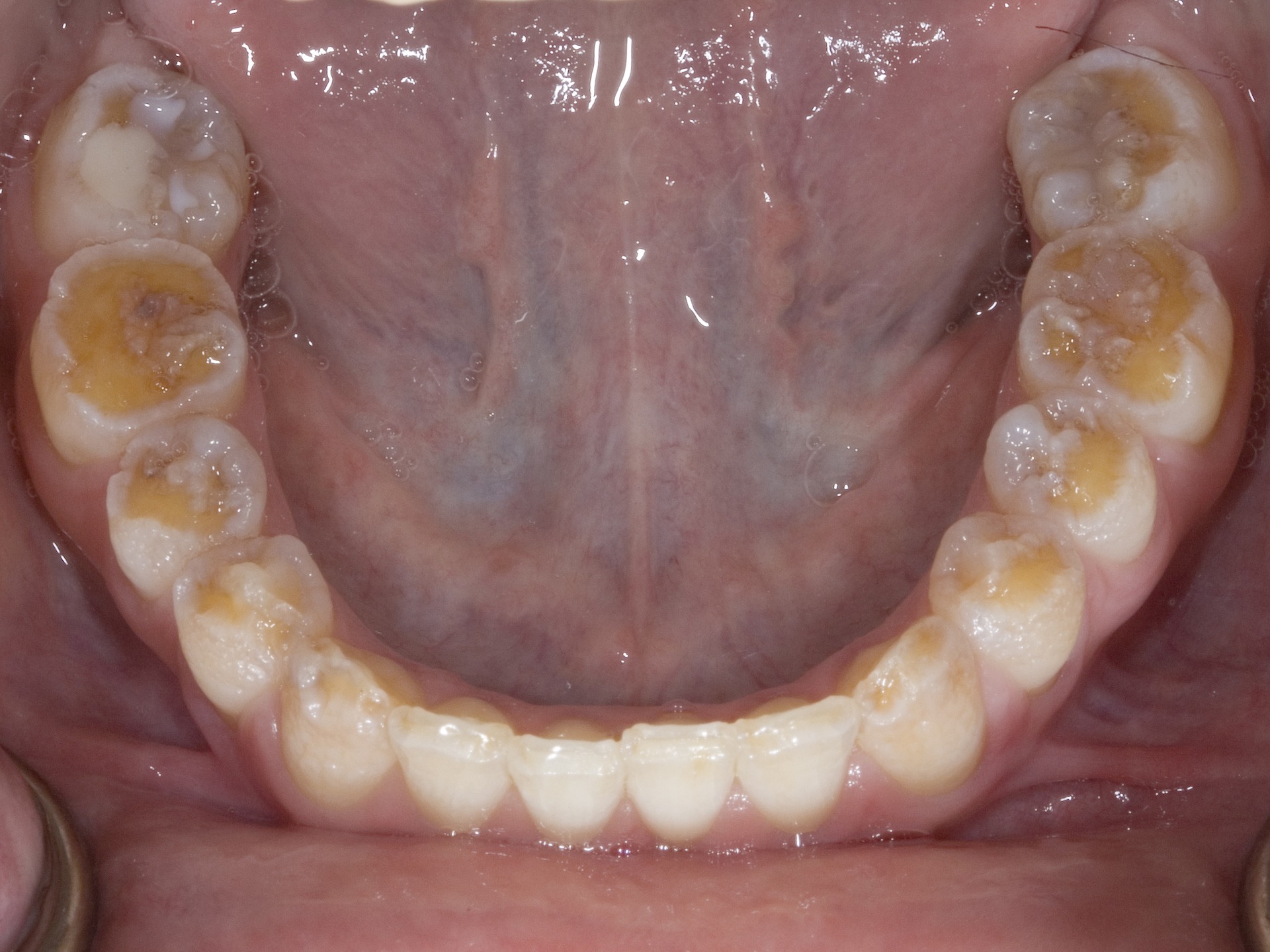 Dental Problems With Celiac Disease Celiac Enamel Defeccts