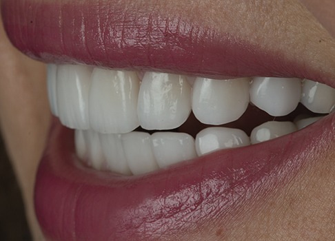 Filling gaps or spaces between the teeth Closing gaps and spaces between the teeth with crowns