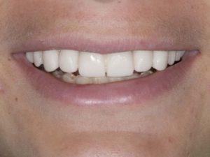 Temporary crowns to confirm phonetics and esthetics Temporary crowns to confirm phonetics and esthetics