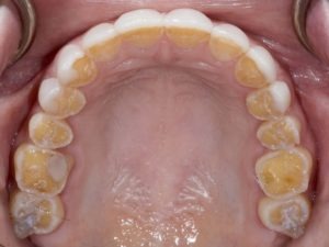 Celiac disease manifests itself dentally Celiac causes harm to both enamel and dentin