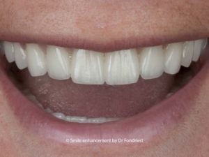 Dental treatment for Celiac sufferers Dental treatment for Celiac sufferers