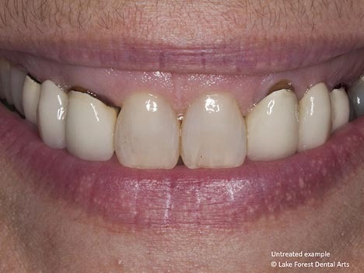 What Are the Lines on the Front of My Teeth? - Sure Dental