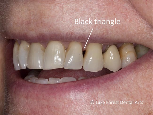 Lost Gum papillae from between teeth