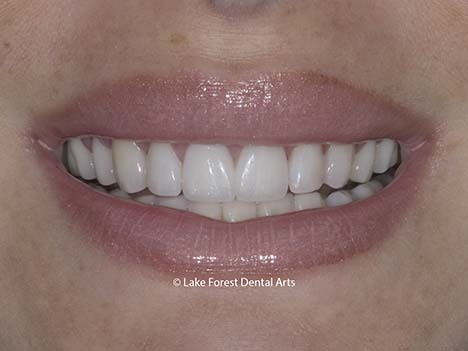 Bruxism veneers for worn teeth