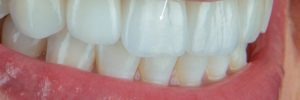 tooth replacement with dental implants