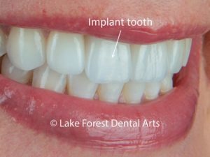 tooth replacement with dental implants