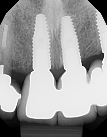 Implant supported crowns