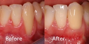 gum graft before and after
