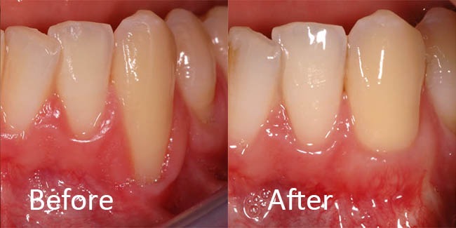 gum recession can be fixed with a gum graft