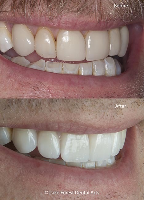teeth before and after veneers