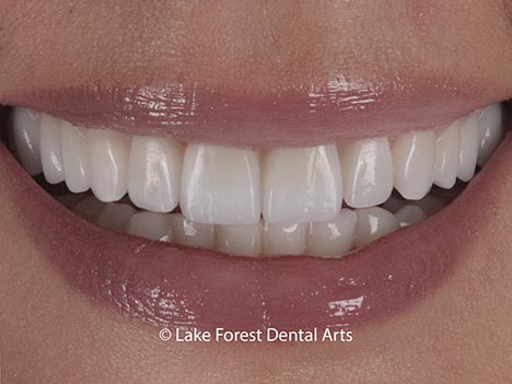 Minimal prep veneers