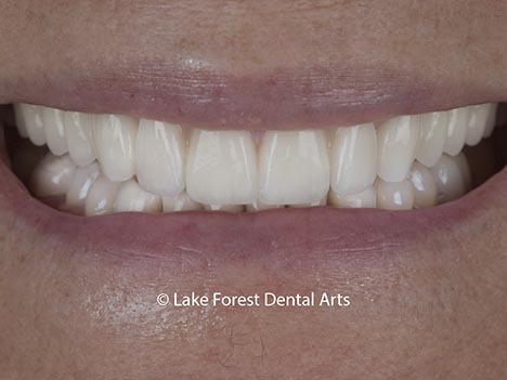 after image of prosthodontic makeover