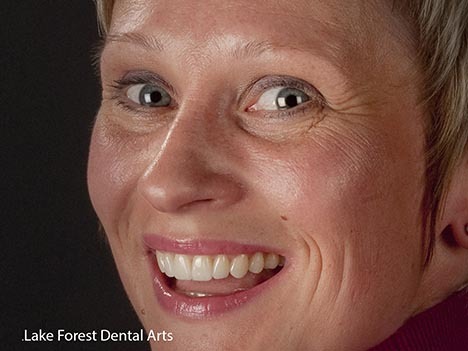 straighten teeth with veneers, veneers to shape teeth, Northfield resident