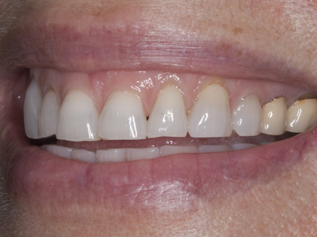 Heavy tooth wear? How to fix a worn smile from bruxism
