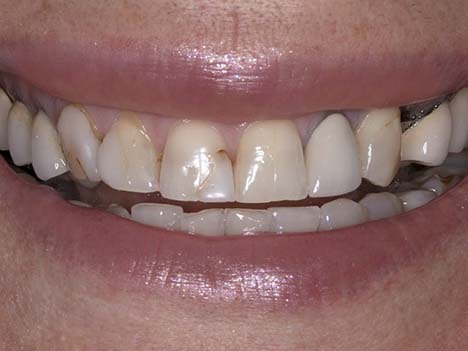 Smile makeover before image