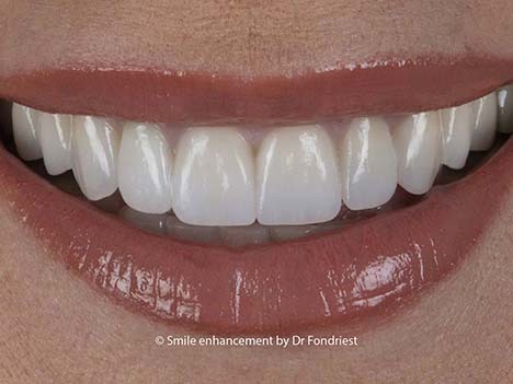 Example of Cosmetic Prosthodontic Treatment
