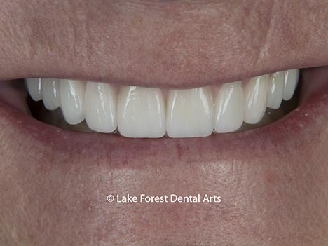 Prosthodontic restoration of smile