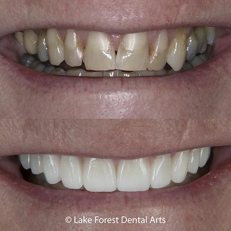 Veneer teeth before and after