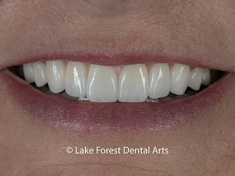 Are veneers better than crowns - after image