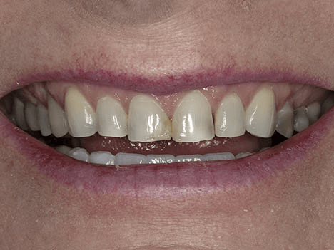 Are veneers better than crowns - before image