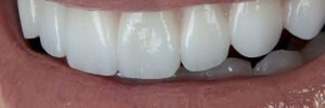 Close the spaces between my teeth