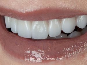Close the spaces between my teeth