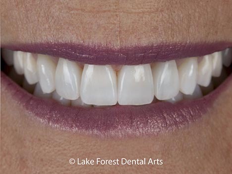 Opalescent Porcelain Veneers