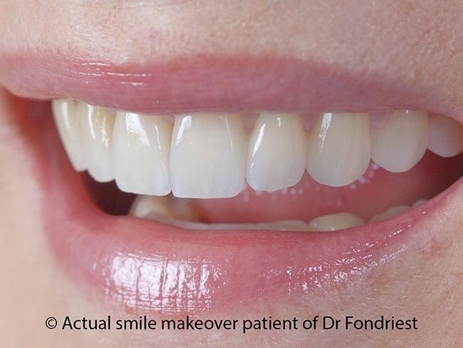 Veneers are worth the cost