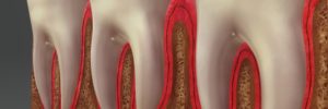 Gum disease