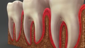 Gum disease