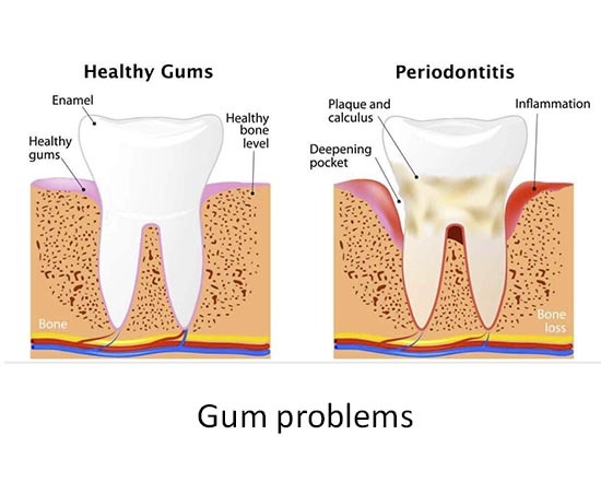 Gum problems