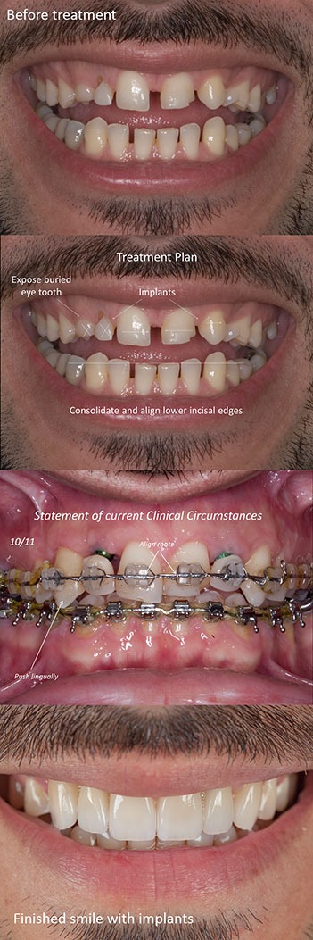 Dental implant teatment