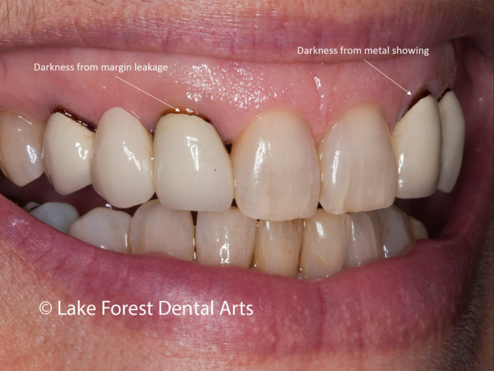 Black Gum Disease   Edge Of Crown Is Dark 1 E1573824819572 