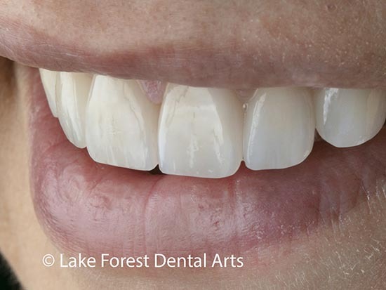 How long do veneers last? | How to preserve their serfvice life