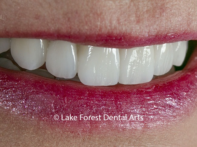 Are veneers better than crowns?