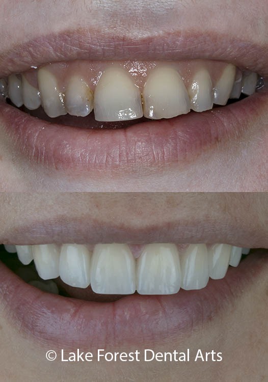 Straighten teeth without braces Dental crowns before and after