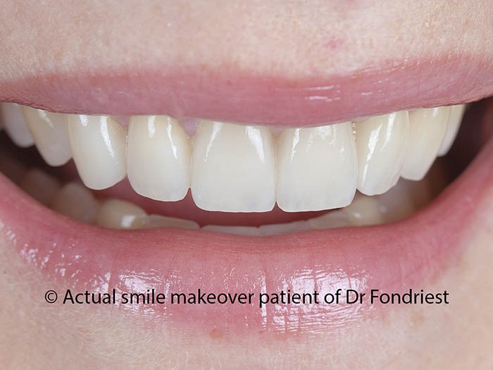 Teeth Makeover A creative and artistic upgrade to your smile