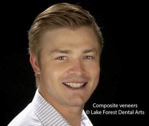 composite veneers