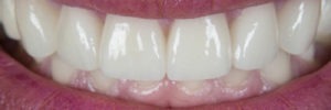 Natural-looking crowns