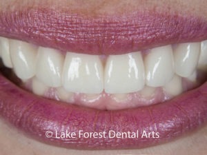 Natural-looking crowns