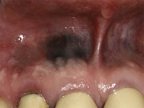 Black gums | Why do I have dark spots on my gum tissue?